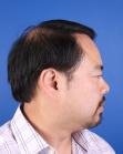 After Hair Transplant&nbsp;Front
